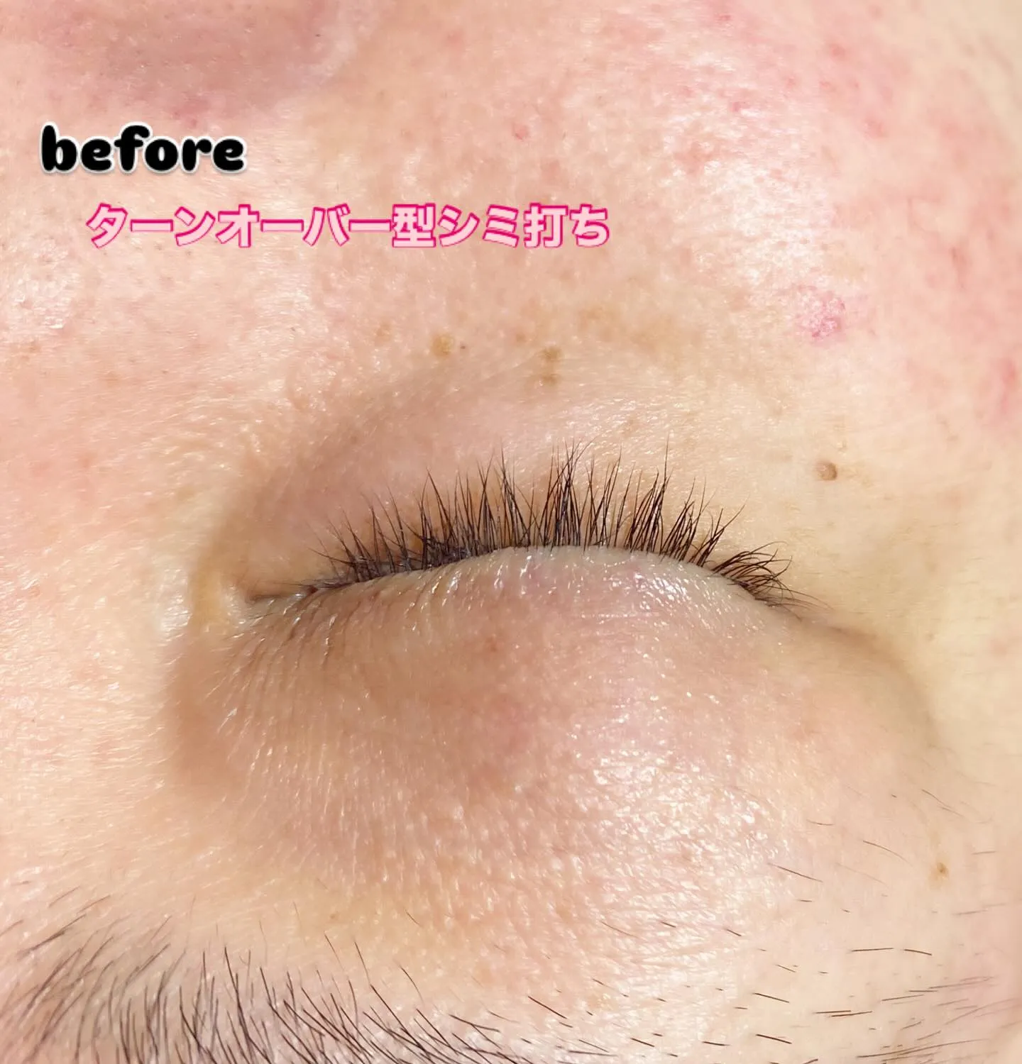 #ターンオーバー型シミ改善