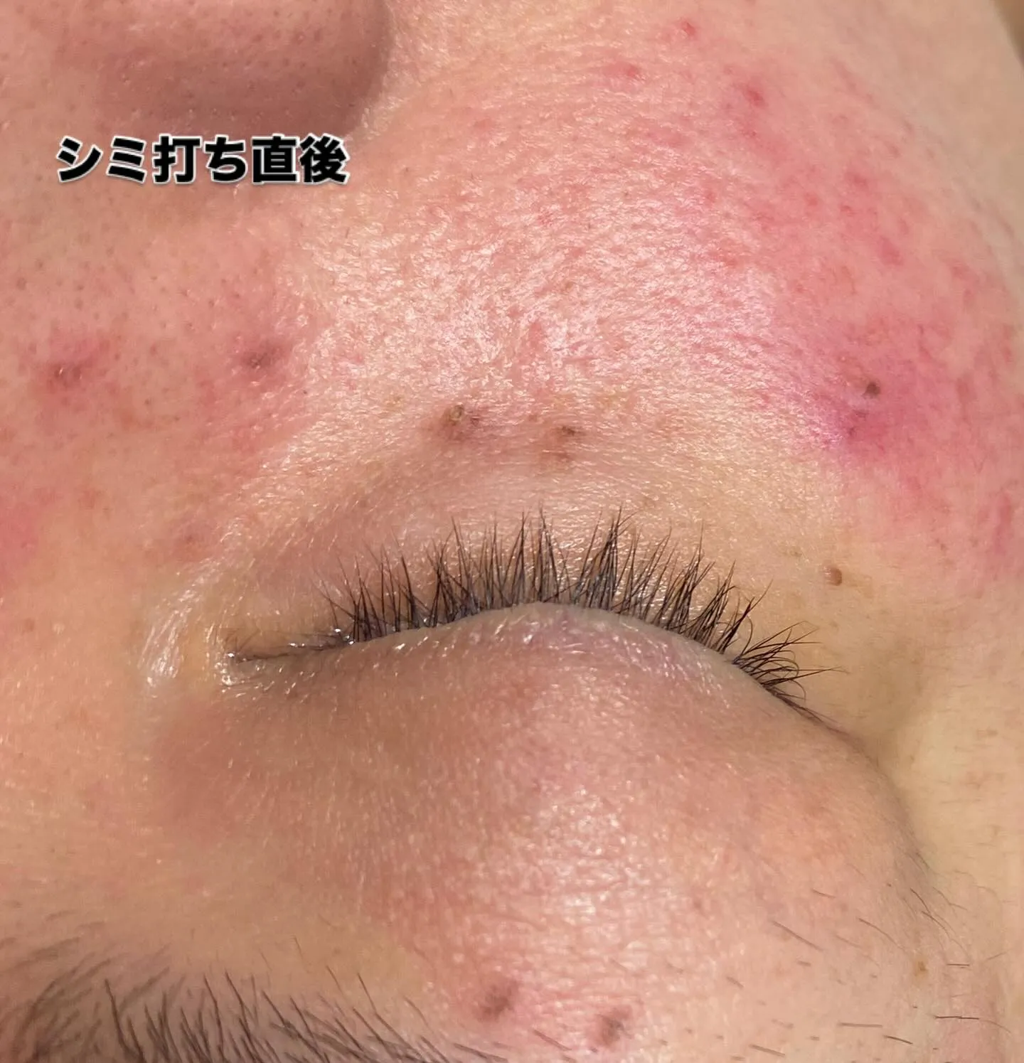 #ターンオーバー型シミ改善