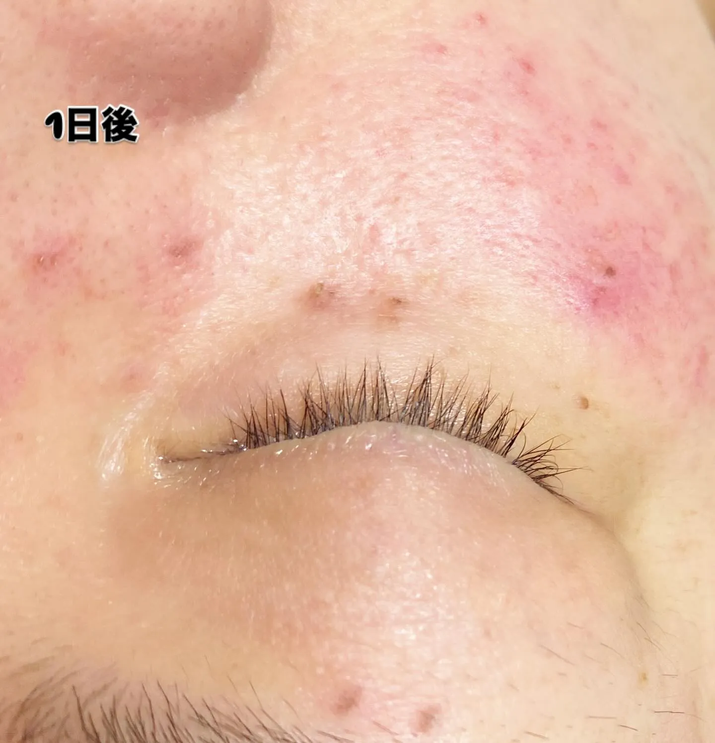 #ターンオーバー型シミ改善